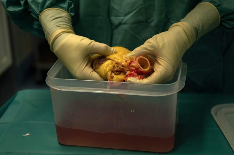 El cirujano cardiovascular Juan Esteban de Villarreal prepara el corazón de un donante para ser implantado en un paciente, en un quirófano del Hospital Universitario Puerta de Hierro en Majadahonda, cerca de Madrid, .