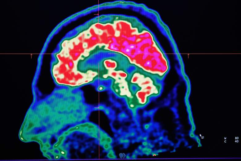 Una imagen de un cerebro humano tomada por un escáner de tomografía por emisión de positrones, también llamado escáner PET, se ve en una pantalla el 9 de enero de 2019, en el Centro Hospitalario Regional y Universitario de Brest (CRHU - Centre Hospitalier Régional et Universitaire de Brest) , oeste de Francia.