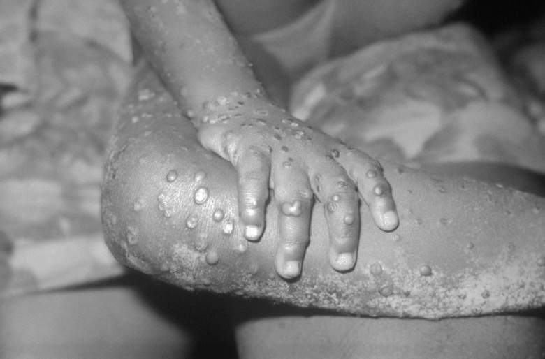 En esta foto del Centro para el Control de Enfermedades de 1971, se muestran lesiones similares a las de la viruela del simio en el brazo y la pierna de una niña en Bondua, Liberia.