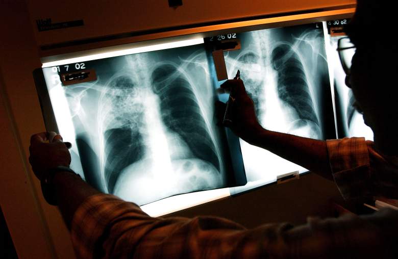 Aumenta tuberculosis en Estados Unidos